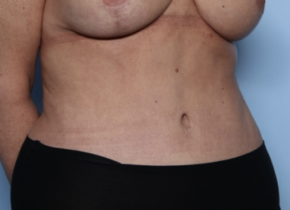 Tummy Tuck Before & After Patient #34291